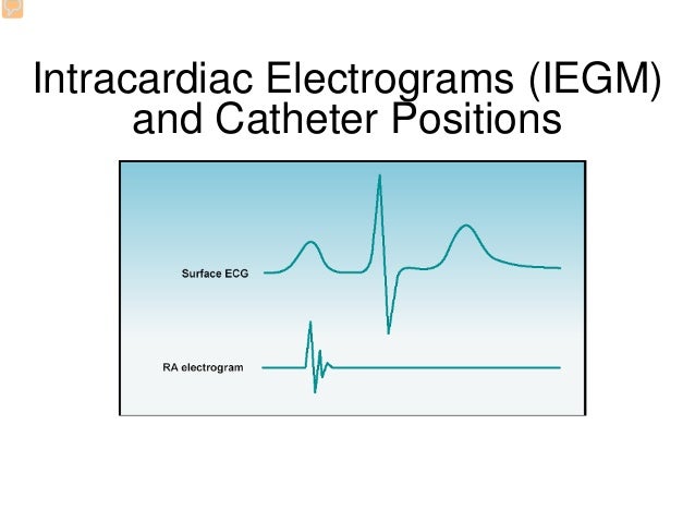 Interpretation of Intracardiac Electrograms: The Fundamentals